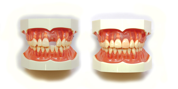 ���Ȃ��ڒ��u���b�W�̃Z���~�b�N�^�C�v�E�����s�`�斃�z�\��