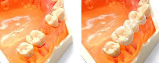 �����̔����ڒ��u���b�W�E�Z���~�b�N�^�C�v�E�����s�`�斃�z�\��