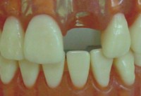 �E�C���O�A�^�b�`�����g�̓��ꎕ